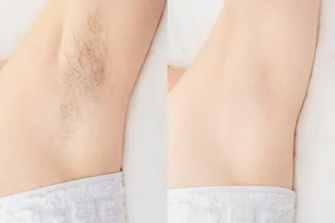 Före och efter laser hårborttagning på armhåla