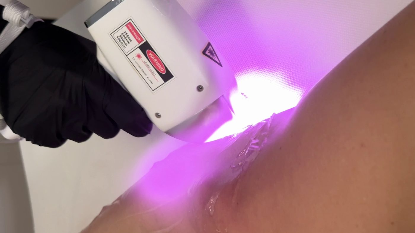 Laser hårborttagning hos AuraLux Laser Clinic i Göteborg